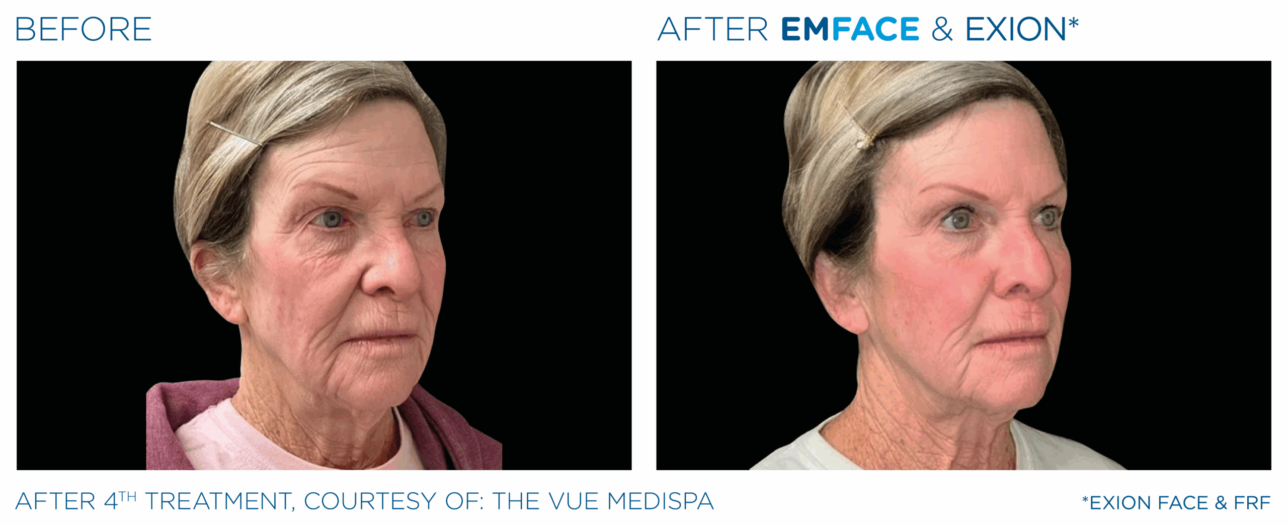 Emface_Exion_PIC_Ba-card-face-female-013_ENUS100