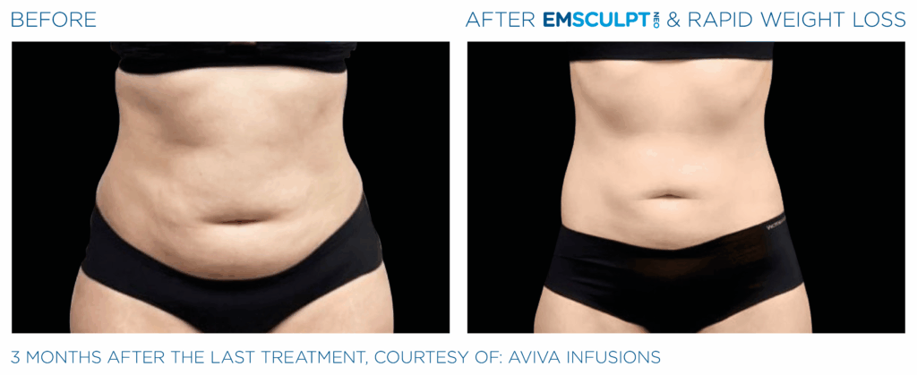 Emsculpt_Neo-Weight-Loss_PIC_Ba-card-female-abdomen-001_ENUS100
