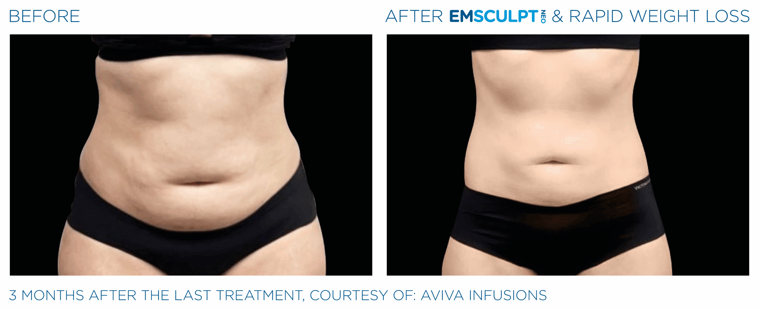 Emsculpt_Neo-Weight-Loss_PIC_Ba-card-female-abdomen-001_ENUS100