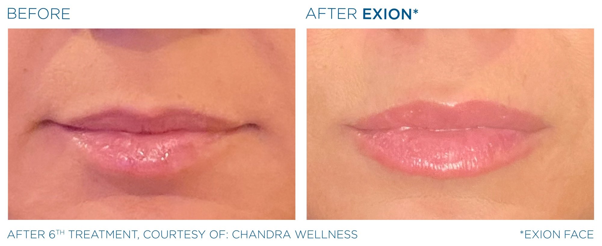 exion female lip treatment